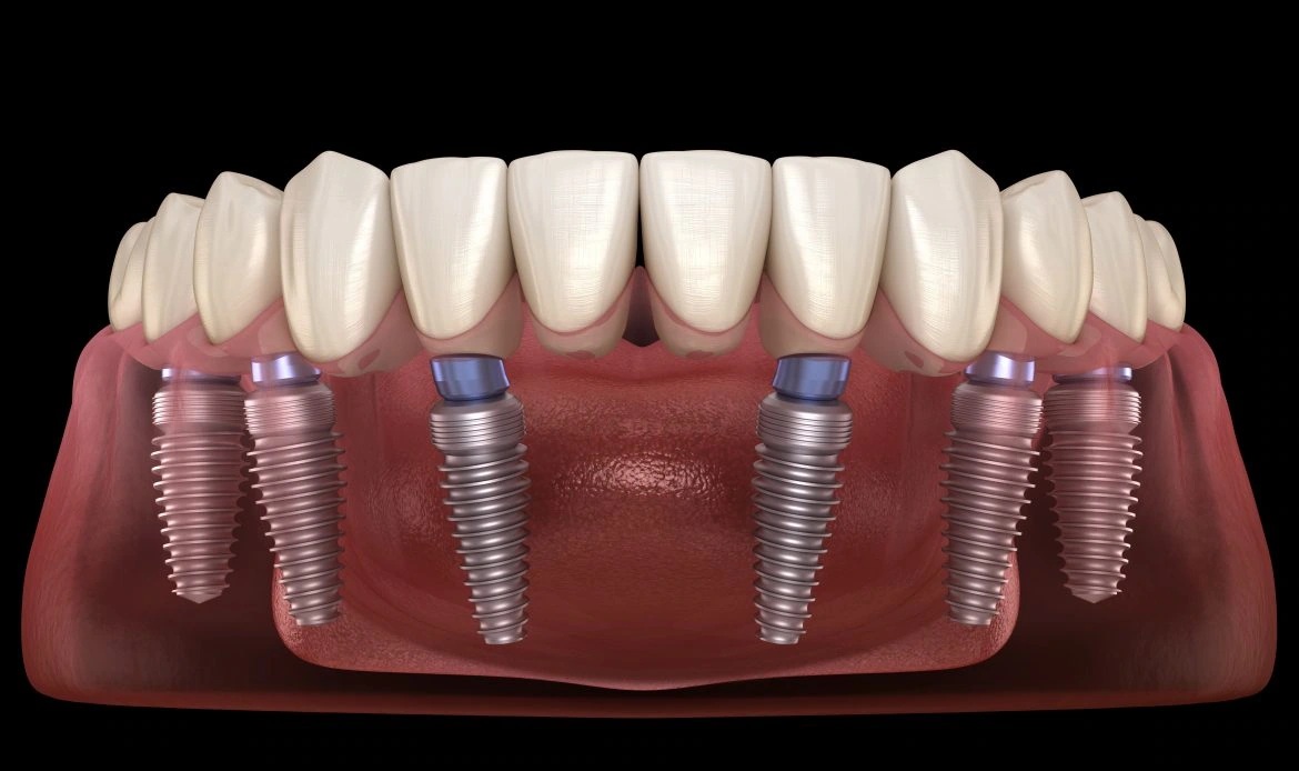 All-on-6 implantes de arcada completa en Smile Implant Center
