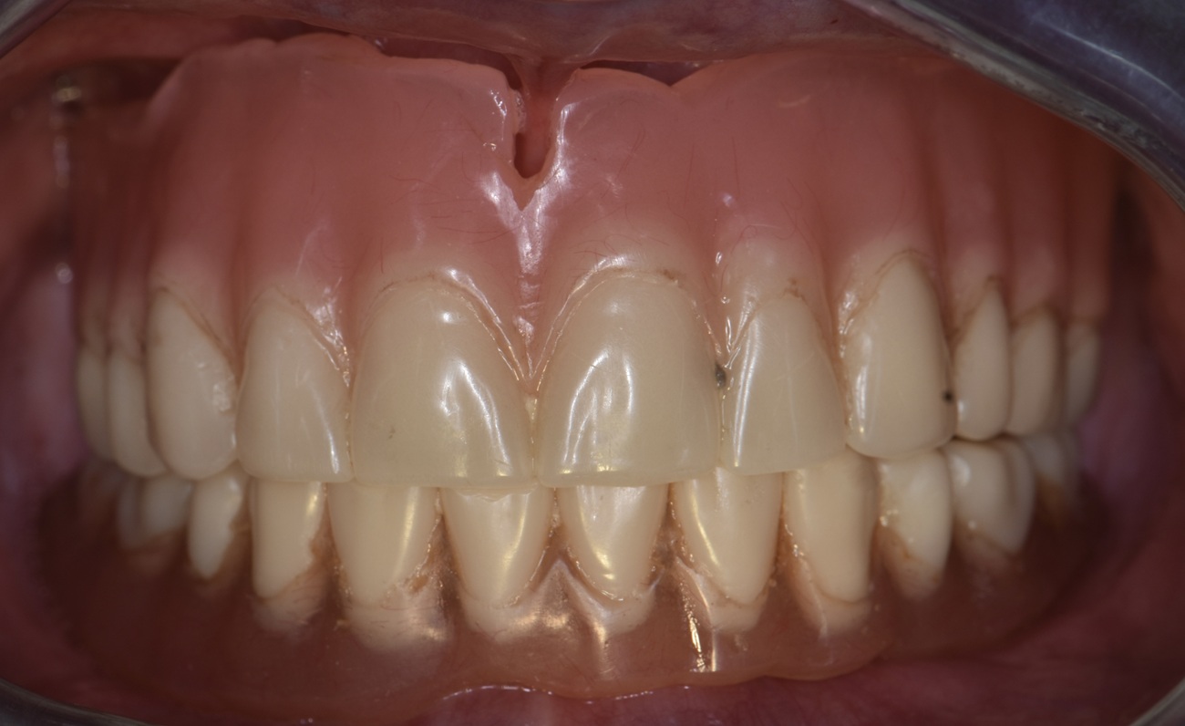 All-on-4 mandibular con pr&oacute;tesis fija cer&aacute;mica - Antes
