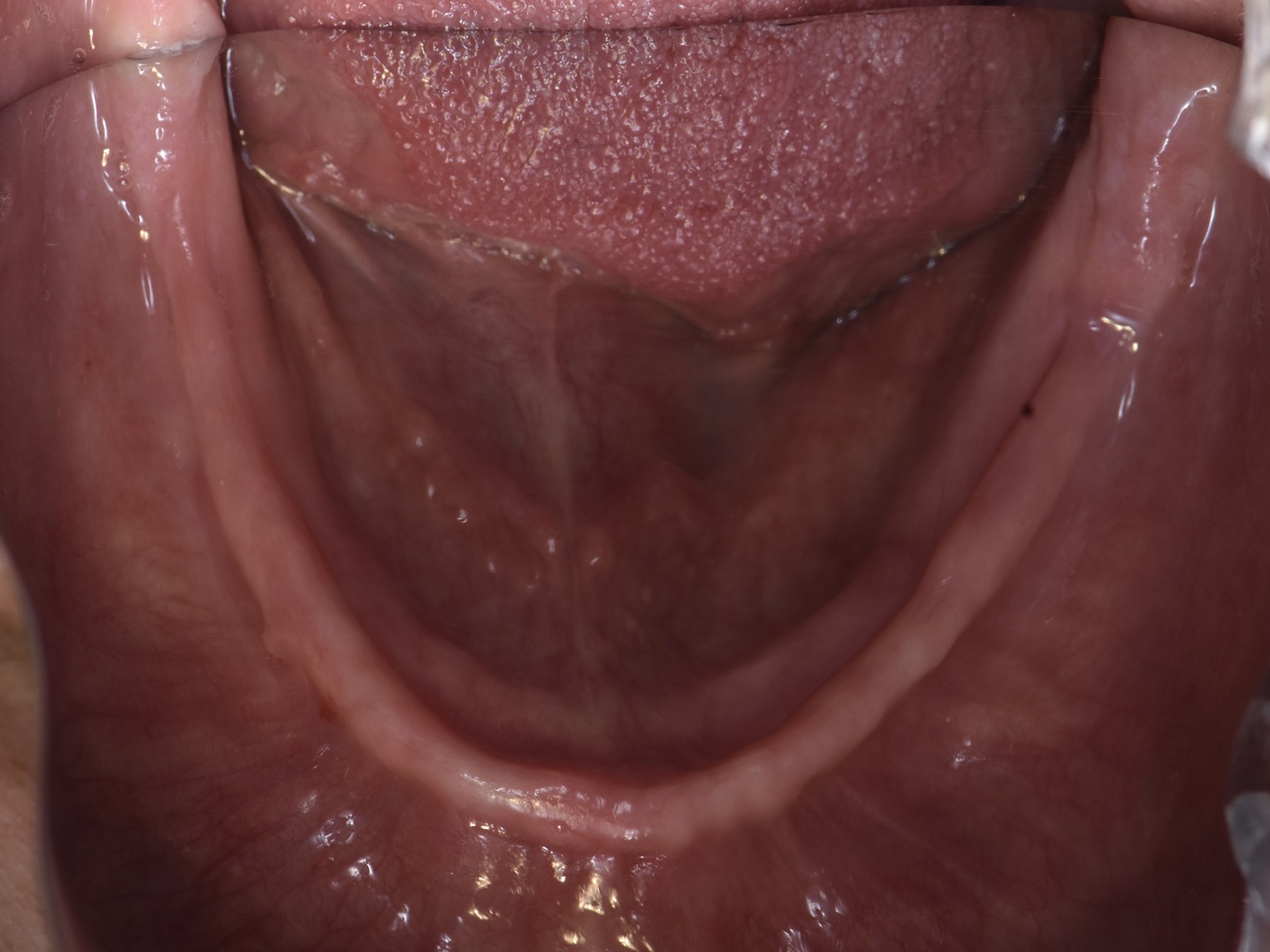 All-on-4 mandibular con pr&oacute;tesis fija cer&aacute;mica - Antes