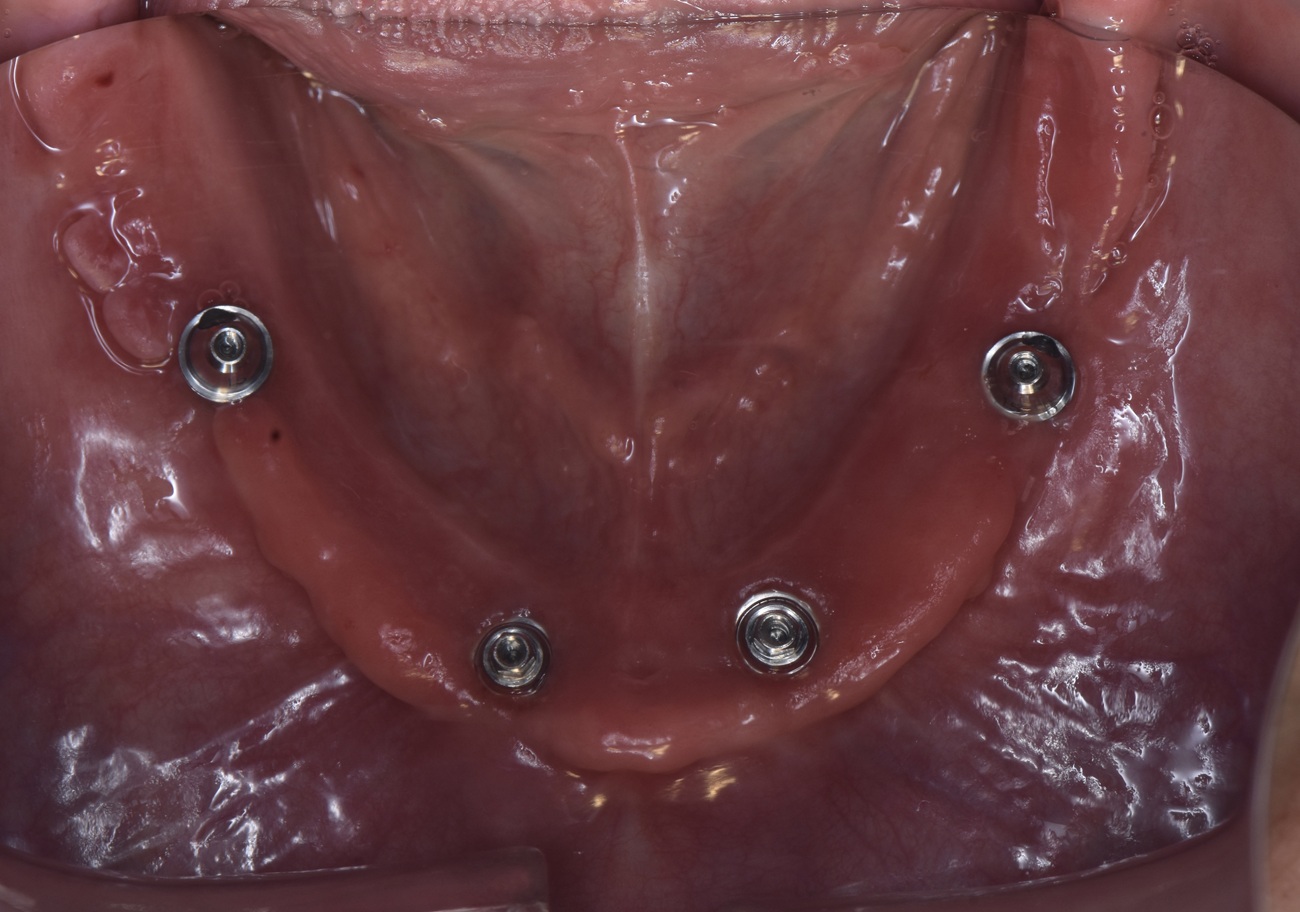 All-on-4 mandibular con pr&oacute;tesis fija cer&aacute;mica - Despu&eacute;s