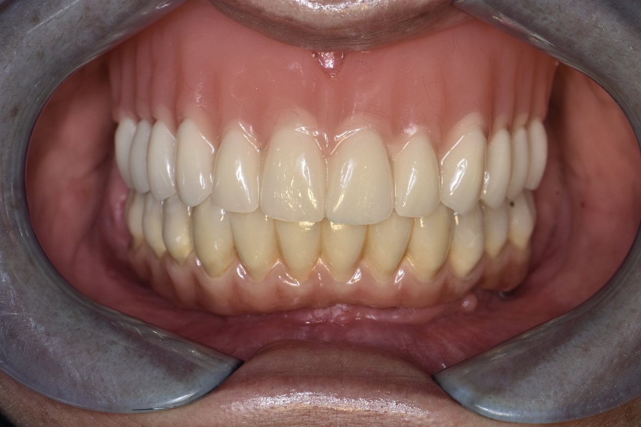 All-on-4 mandibular con pr&oacute;tesis fija cer&aacute;mica - Despu&eacute;s