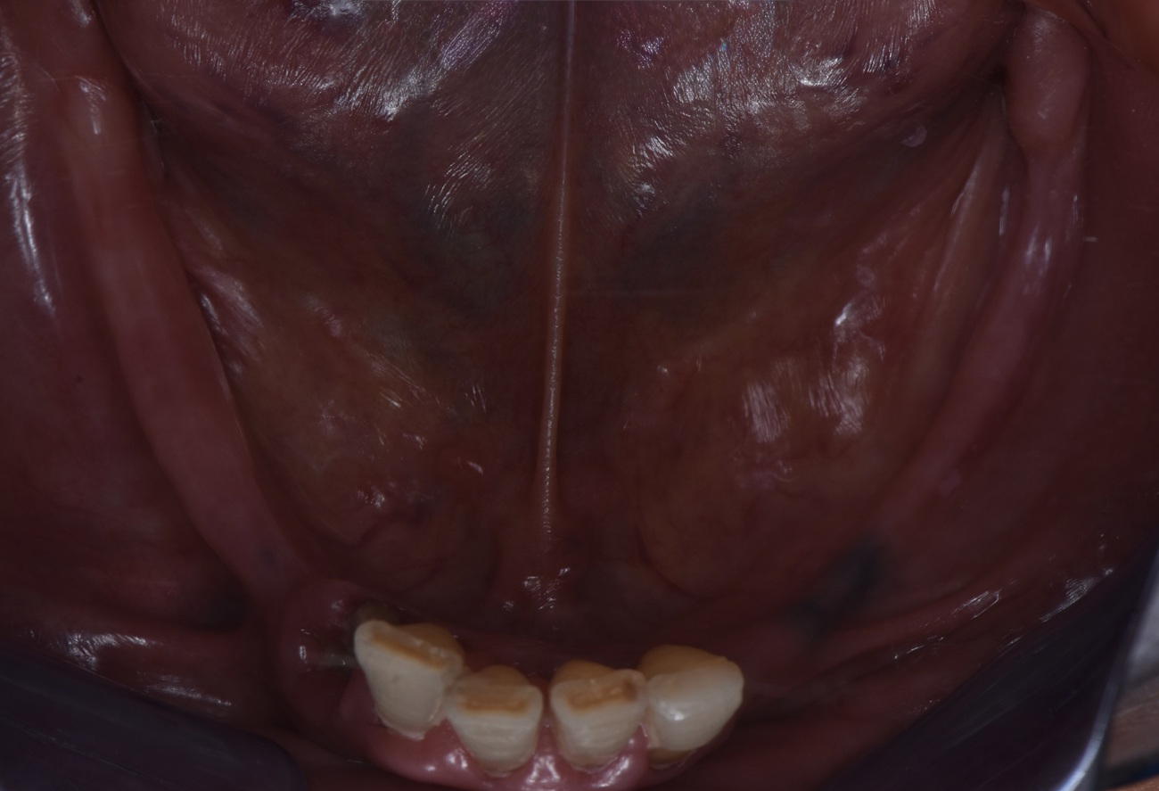 Mand&iacute;bula parcialmente ed&eacute;ntula con extracci&oacute;n, regularizaci&oacute;n e implantes - Antes