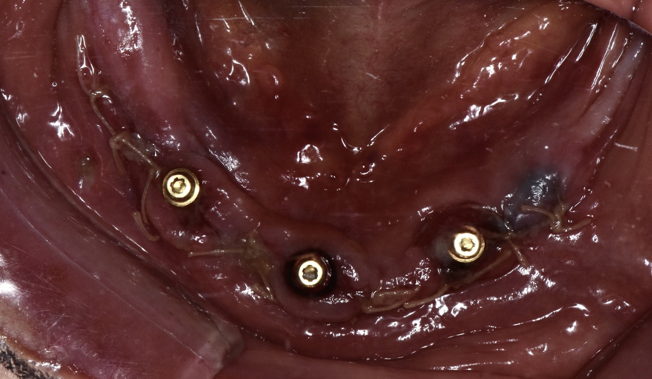 Mand&iacute;bula parcialmente ed&eacute;ntula con extracci&oacute;n, regularizaci&oacute;n e implantes - Despu&eacute;s