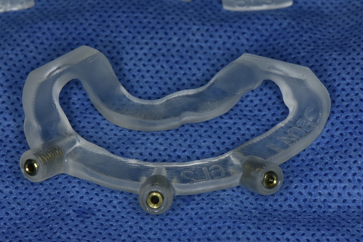 Cirugía guiada para implantes dentales en Smile Implant Center CDMX